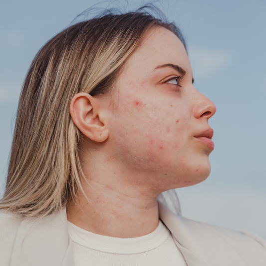 Top Natural Treatments for Acne in Ohio: A Holistic Esthetician’s Guide